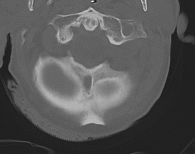 Acute on chronic subdural hematoma and thoracic vertebral injury in a multitrauma patient (Radiopaedia 31698-32619 Axial bone window 13).jpg