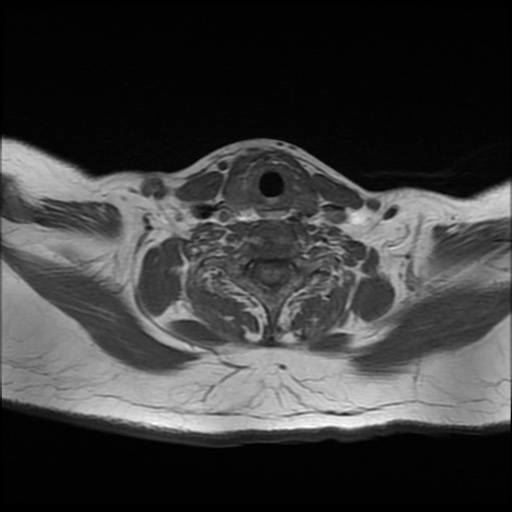 File:Acute otitis externa (Radiopaedia 57296-64236 Axial T1 30).jpg