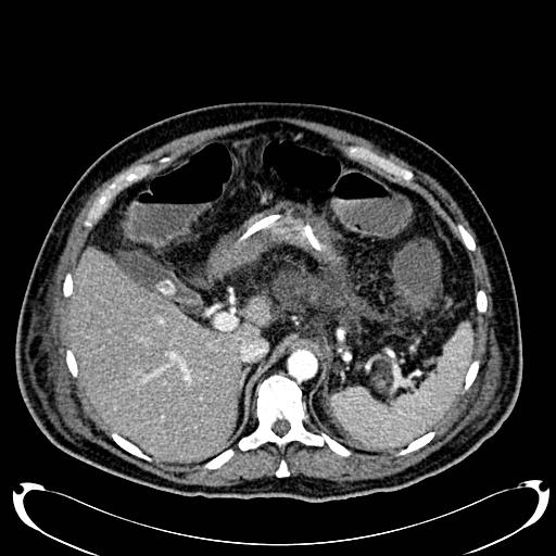 Acute pancreatic necrosis (Radiopaedia 13560-18500 Axial C+ portal venous phase 42).jpg