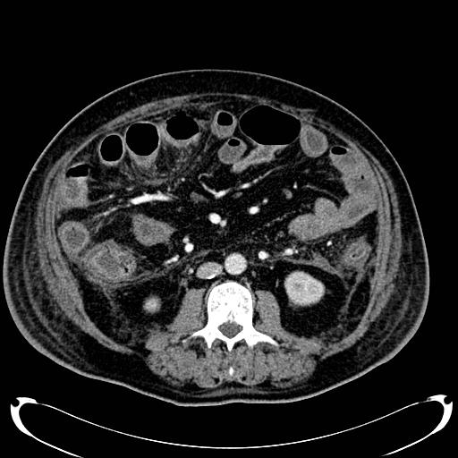 Acute pancreatic necrosis (Radiopaedia 13560-18500 Axial C+ portal venous phase 85).jpg