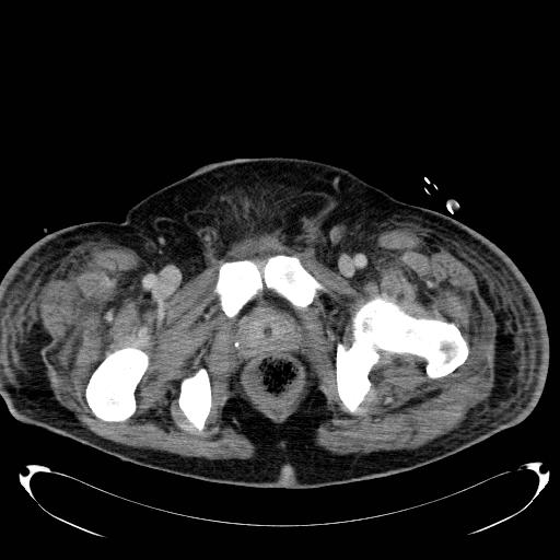 Acute pancreatic necrosis (Radiopaedia 13560-18503 Axial C+ portal venous phase 84).jpg