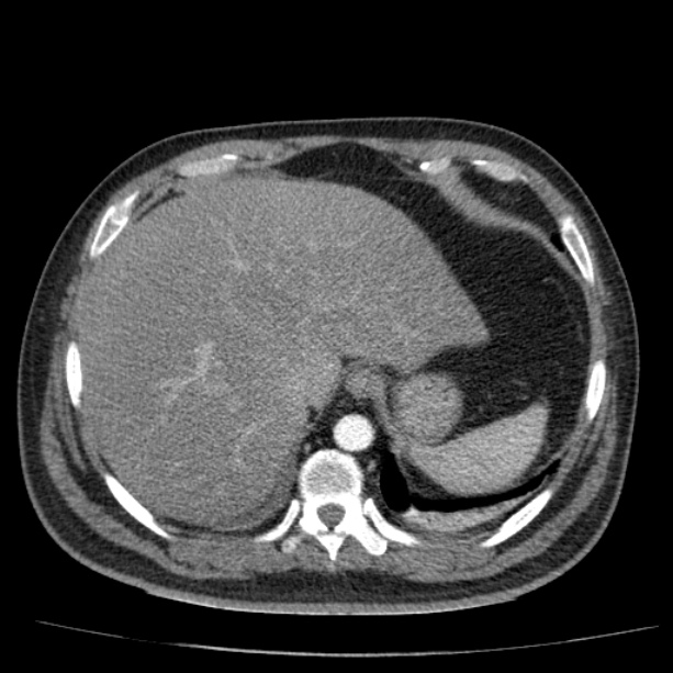 Acute pancreatitis (Radiopaedia 26663-26813 Axial C+ arterial phase 20).jpg
