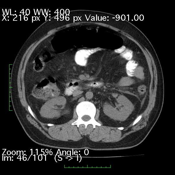 Acute pancreatitis (Radiopaedia 34043-35276 Axial non-contrast 46).jpg