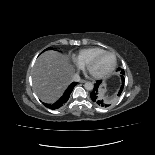 Acute pancreatitis (Radiopaedia 80007-93285 Axial C+ portal venous phase 9).jpg