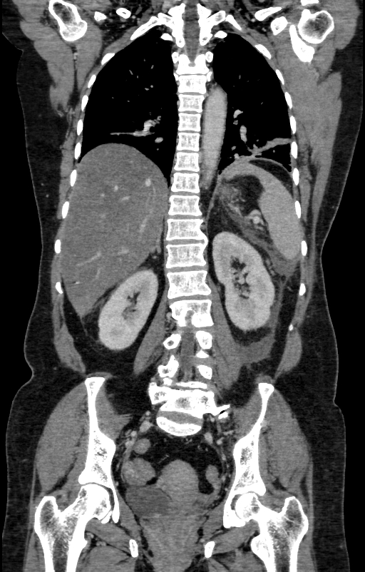 Acute pancreatitis (Radiopaedia 80007-93285 Coronal C+ portal venous phase 104).jpg