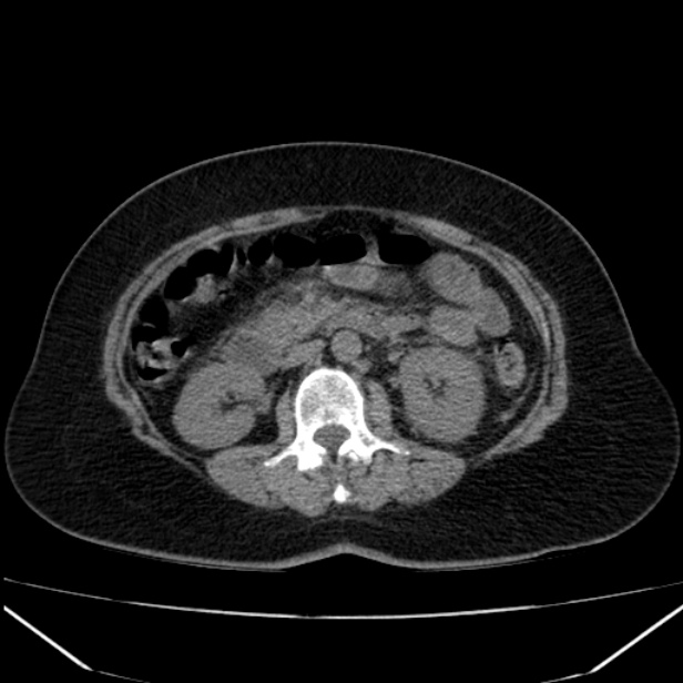 Acute pancreatitis - Balthazar C (Radiopaedia 26569-26714 Axial non-contrast 44).jpg