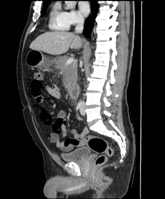 Acute pancreatitis - Balthazar E (Radiopaedia 23080-23110 Sagittal C+ portal venous phase 47).jpg