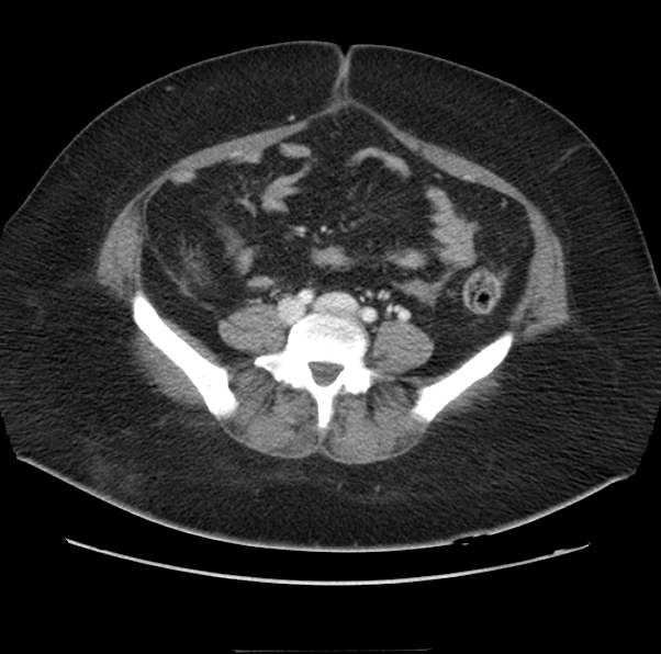 File:Acute pancreatitis - Balthazar E (Radiopaedia 29016-29377 Axial C+ portal venous phase 48).png