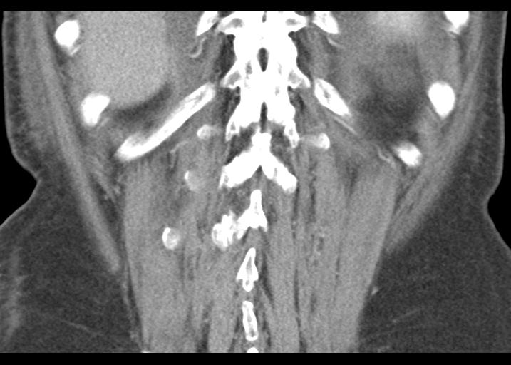 Acute pancreatitis and walled-off necrosis (Radiopaedia 29888-30403 Coronal C+ portal venous phase 48).jpg