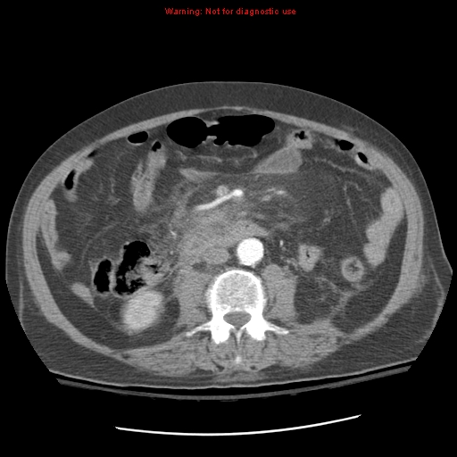 File:Acute pancreatitis with incidental pancreatic lipoma (Radiopaedia 10190-10730 Axial C+ arterial phase 56).jpg