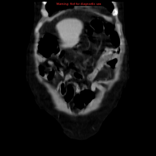 Acute pancreatitis with incidental pancreatic lipoma (Radiopaedia 10190-10730 Coronal C+ portal venous phase 10).jpg