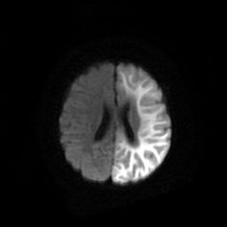 File:Acute phase of hemiconvulsion-hemiplegia epilepsy syndrome (Radiopaedia 29309-29745 Axial DWI 16).jpg
