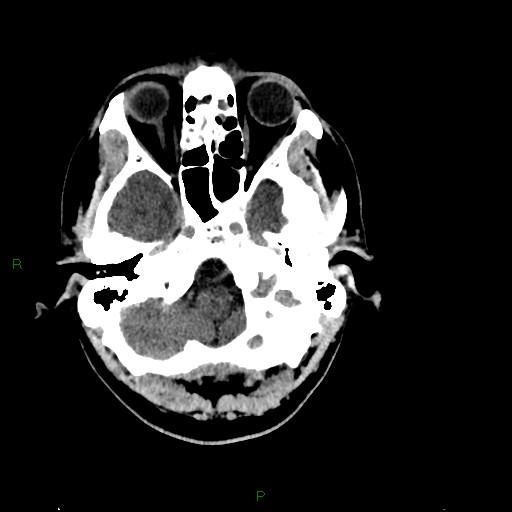 Acute posterior cerebral artery territory infarct (Radiopaedia 79329-92393 Axial non-contrast 18).jpg