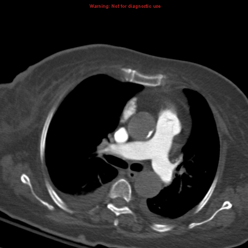 Acute pulmonary embolism (Radiopaedia 13286-13289 Axial C+ CTPA 30).jpg