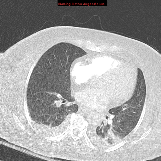 File:Acute pulmonary embolism (Radiopaedia 13286-13289 B 24).jpg