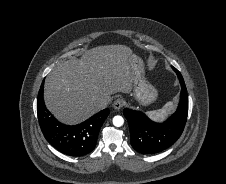 Acute pulmonary embolism with pulmonary infarcts (Radiopaedia 77688-89908 Axial C+ CTPA 57).jpg