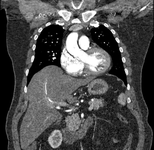 Acute pulmonary embolism with pulmonary infarcts (Radiopaedia 77688-89908 Coronal C+ CTPA 28).jpg