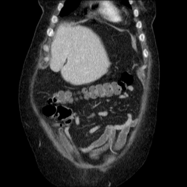 Acute pyelonephritis (Radiopaedia 26584-26729 C+ portal venous phase 17).jpg