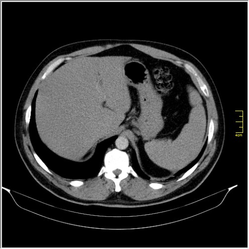 File:Acute right sided diverticulitis (Radiopaedia 65249-74268 Axial C+ portal venous phase 13).JPG