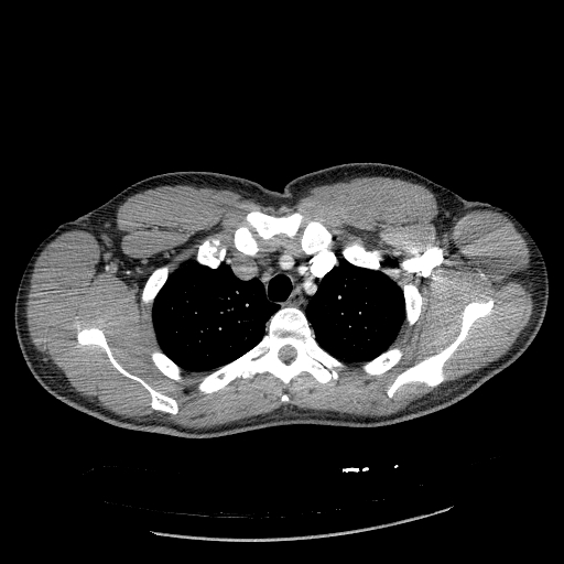 Acute segmental pulmonary emboli and pulmonary infarction (Radiopaedia 62264-70444 Axial C+ CTPA 27).jpg