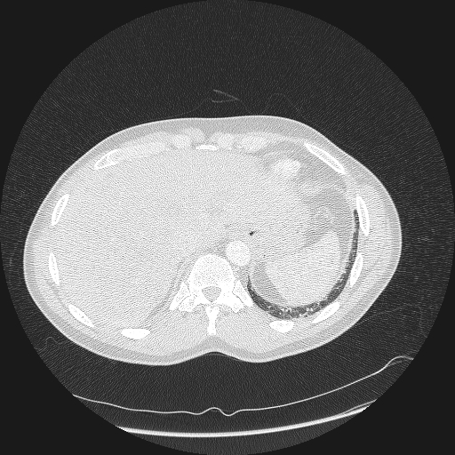 Acute segmental pulmonary emboli and pulmonary infarction (Radiopaedia 62264-70444 Axial lung window 176).jpg