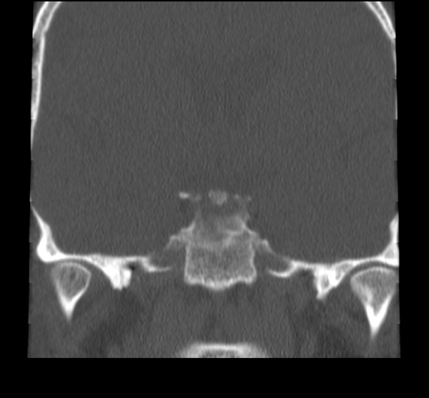 File:Acute sinusitis (Radiopaedia 23161-23215 Coronal bone window 58).jpg