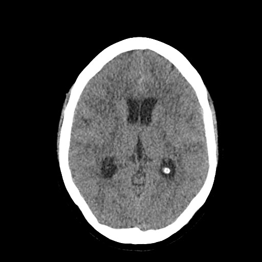 Acute subarachnoid hemorrhage and accessory anterior cerebral artery (Radiopaedia 69231-79008 Axial non-contrast 28).jpg