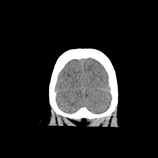 Acute subarachnoid hemorrhage and accessory anterior cerebral artery (Radiopaedia 69231-79008 Coronal non-contrast 63).jpg