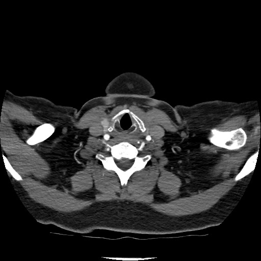 Acute subarachnoid hemorrhage and accessory anterior cerebral artery (Radiopaedia 69231-79009 Axial C+ arterial phase 38).jpg