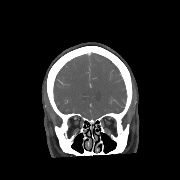 Acute subarachnoid hemorrhage and accessory anterior cerebral artery (Radiopaedia 69231-79009 Coronal C+ arterial phase 24).jpg