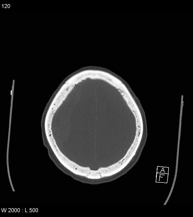 Acute subdural hematoma with myelofibrosis (Radiopaedia 52582-58494 Axial bone window 60).jpg