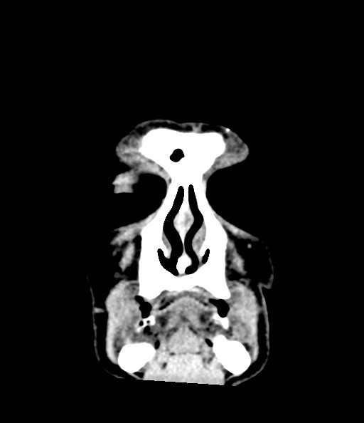 Acute superior cerebellar artery territory infarct (Radiopaedia 84104-99359 Coronal non-contrast 18).jpg