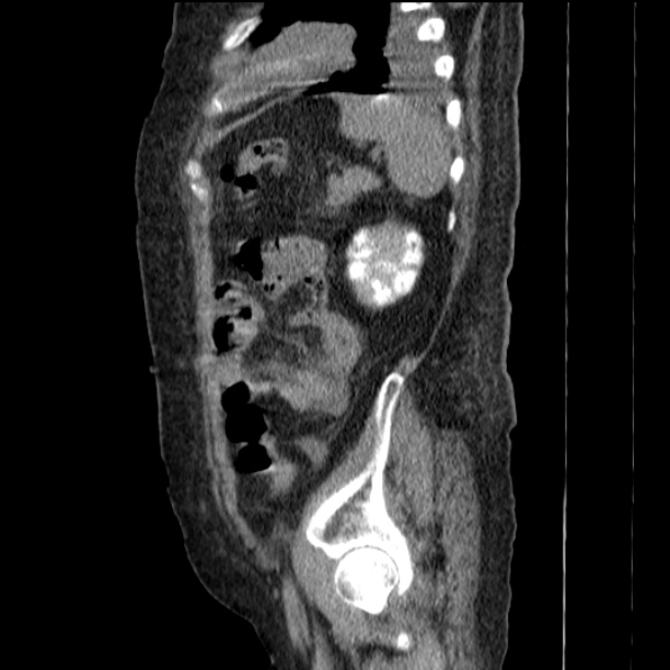 Acute tubular necrosis (Radiopaedia 28077-28334 Sagittal non-contrast 69).jpg