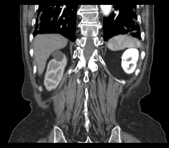 Adenocarcinoma of cecum (Radiopaedia 59222-66549 Coronal C+ arterial phase 60).jpg