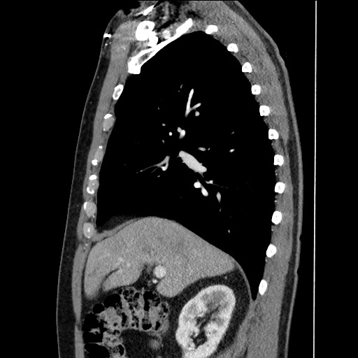 File:Adenocarcinoma of the lung (Radiopaedia 59871-67325 Sagittal C+ arterial phase 33).jpg