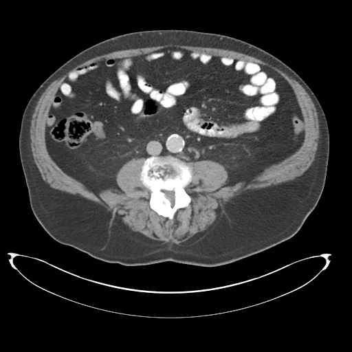 Adenocarcioma of rectum- T1 lesion (Radiopaedia 36921-38547 Axial C+ portal venous phase 52).png