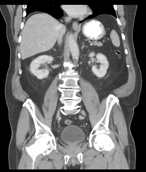 Adenocarcioma of rectum- T1 lesion (Radiopaedia 36921-38547 Coronal C+ portal venous phase 37).png