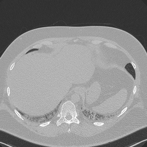 Adenoid cystic carcinoma of the trachea (Radiopaedia 49042-54137 Axial lung window 297).jpg