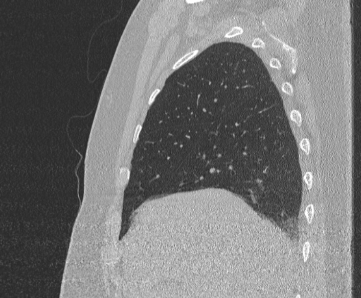 Adenoid cystic carcinoma of the trachea (Radiopaedia 49042-54137 Sagittal lung window 108).jpg