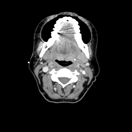 File:Adenoid cystic tumor of palate (Radiopaedia 46980-51518 Axial C+ delayed 37).png