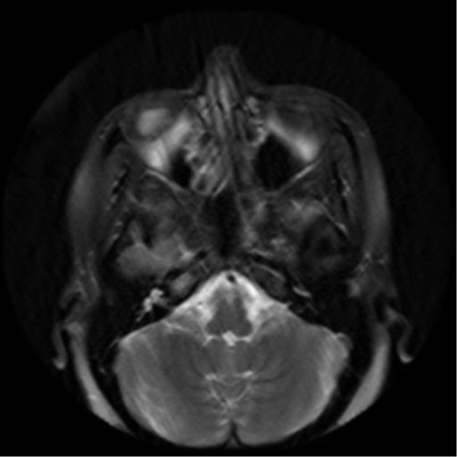 File:Adenoid cystic tumor of palate (Radiopaedia 46980-51519 Axial T2 28).png