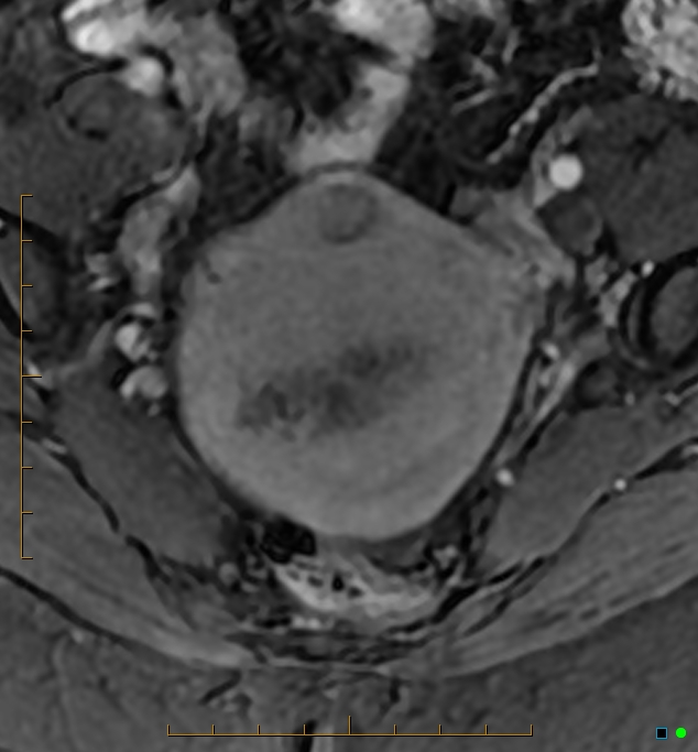 Adenomyosis uterus with hematometra (Radiopaedia 45779-50011 Axial T1 C+ fat sat 15).jpg