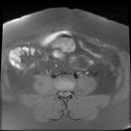 File:Adenomyosis within a didelphys uterus (Radiopaedia 70175-80215 Axial T1 fat sat 11).jpg