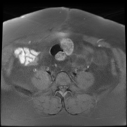 File:Adenomyosis within a didelphys uterus (Radiopaedia 70175-80215 Axial T1 fat sat 13).jpg