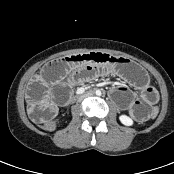 Adhesional small bowel obstruction (Radiopaedia 48397-53305 Axial C+ portal venous phase 39).jpg