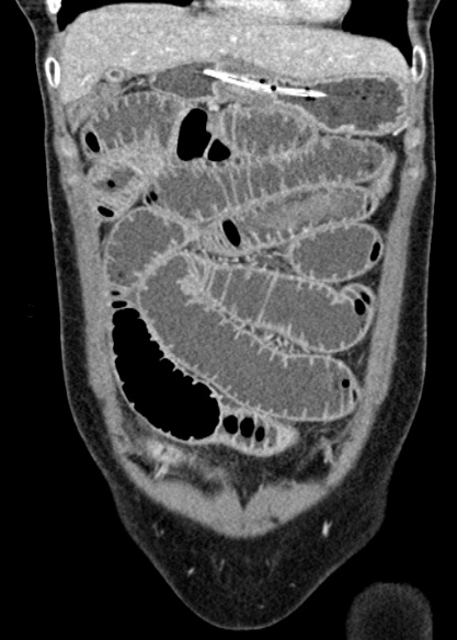 Adhesional small bowel obstruction (Radiopaedia 48397-53305 Coronal C+ portal venous phase 89).jpg