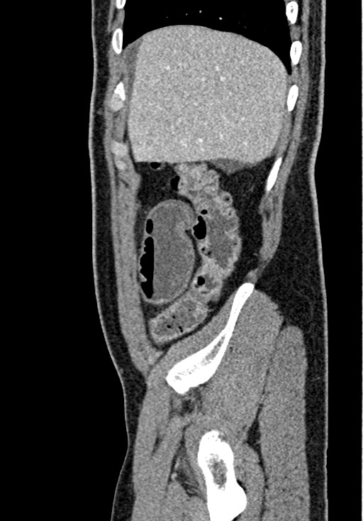 Adhesional small bowel obstruction (Radiopaedia 58900-66131 Sagittal C+ portal venous phase 43).jpg