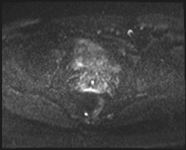 Adnexal multilocular cyst (O-RADS US 3- O-RADS MRI 3) (Radiopaedia 87426-103754 Axial DWI 48).jpg