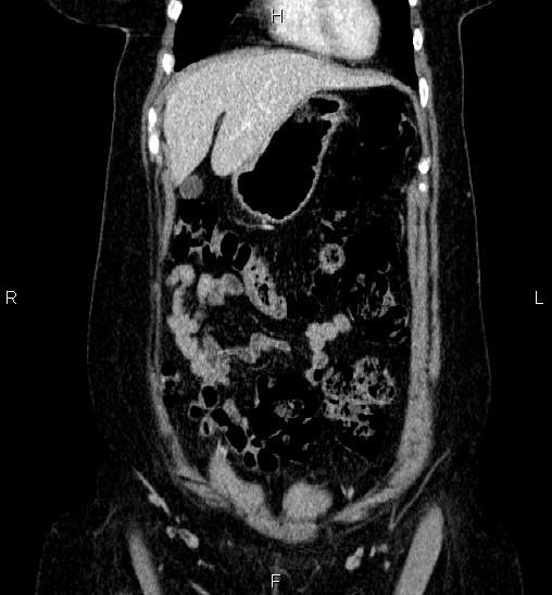 Adrenal cortical carcinoma (Radiopaedia 84882-100379 Coronal C+ portal venous phase 12).jpg