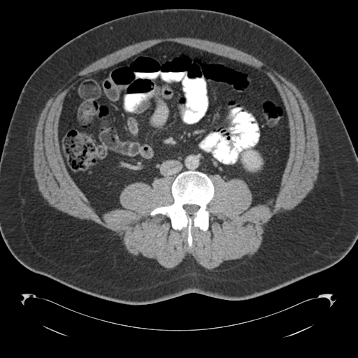 File:Adrenal cyst (Radiopaedia 45625-49776 Axial C+ portal venous phase 55).png